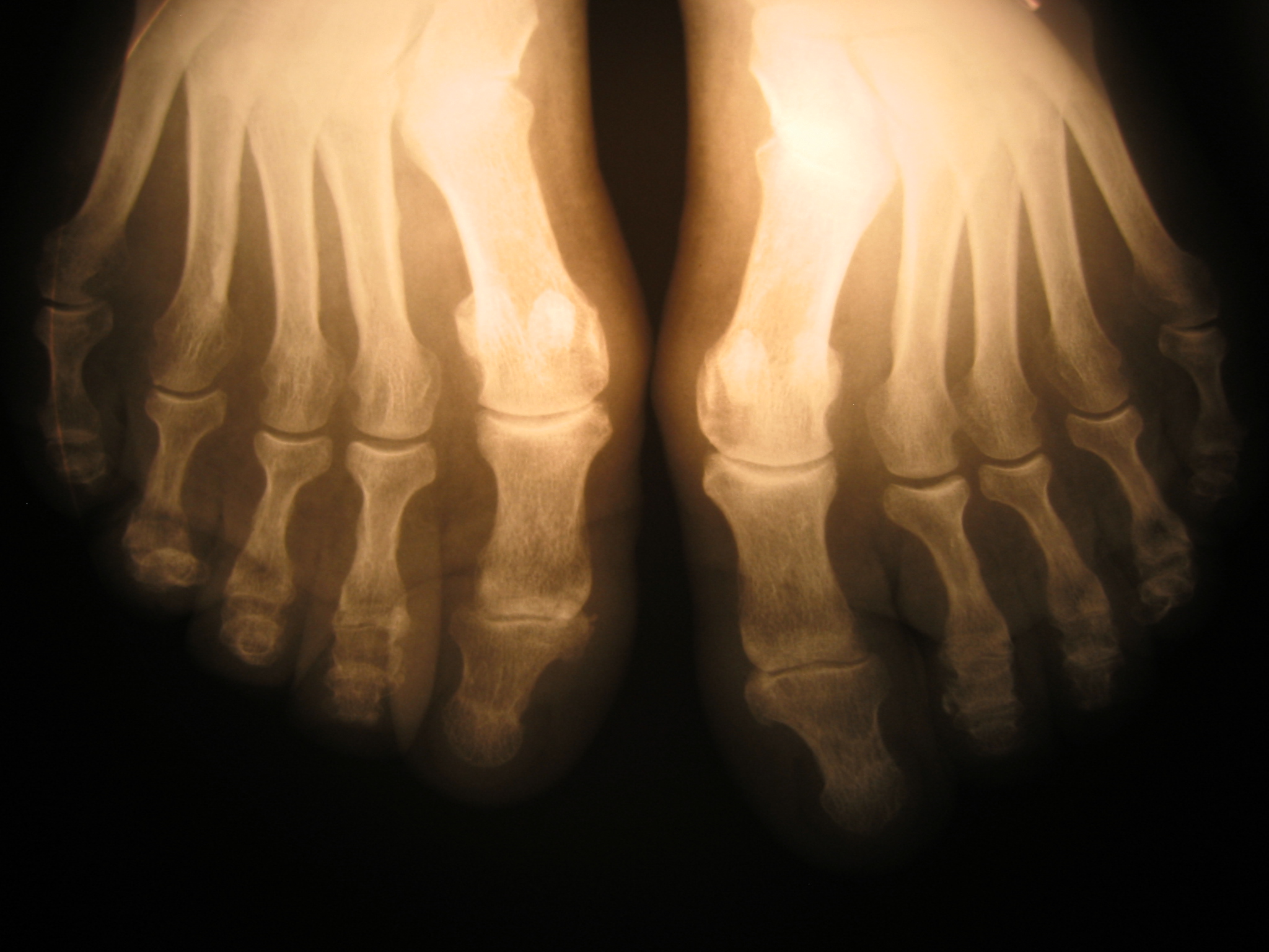x-ray-foot-1435088